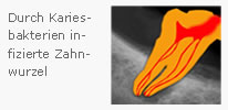 Wurzelkanalbehandlung